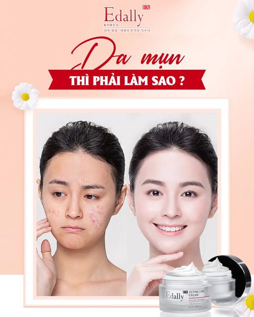 DA MỤN THÌ PHẢI LÀM SAO? 