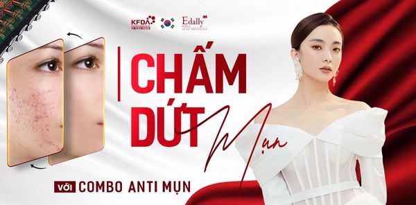Mụn là nỗi đau không chỉ ở mỗi các chị em phụ nữ mà còn ở cả các anh em giai
